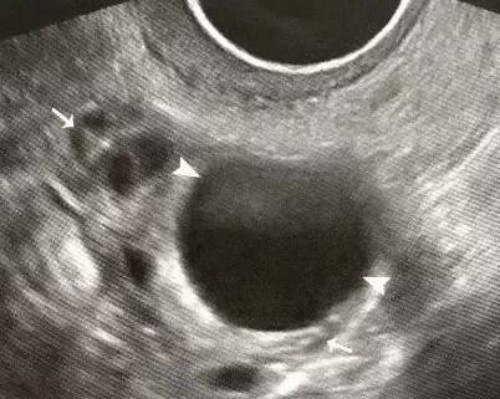 重庆助孕代怀：关于孩子18号染色体偏多的问题，了解多一条可能引发的致畸情况！